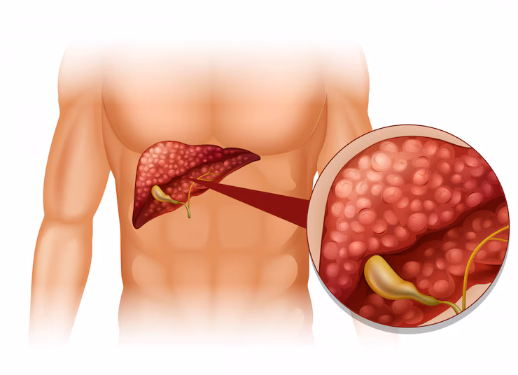 MySmartCare360 | Hyperlipidemia -  Image Name 
