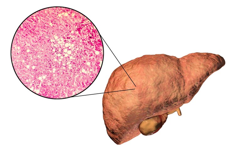 MySmartCare360 | Hepatitis -  Image Name 